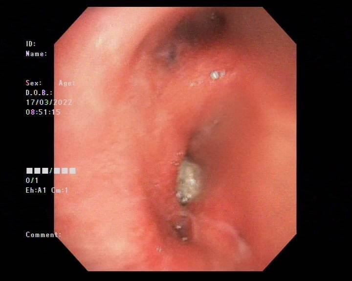 Bệnh viện Phổi Hải Phòng thực hiện ca nội soi gắp thành công dị vật là một mảnh xương trong lòng phế quản.