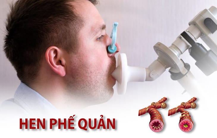 GIÃN PHẾ NANG – NGUYÊN NHÂN, DẤU HIỆU VÀ ĐIỀU TRỊ